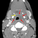 Extensive submucosal edema surrounding the airway (red arrows). There is an apparent tiny fluid collection in the vallecula (yellow arrow), which may represent fluid extending into a tonsillar crypt or a small developing submucosal collection.