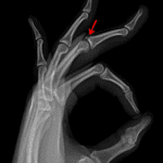 Avulsion fracture at the dorsal base of the third middle phalanx (red arrow).