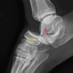Chopart dislocation with impacted fractures of the anterior process of the calcaneus (red arrow) and along the plantar margin of the navicular (yellow arrow).