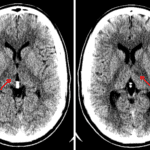 Red arrows indicate the subtle areas of hypoattenuation in the bilateral thalami.