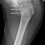 Arrows indicate the proximal humeral epiphysis, physis (lucent line), and metaphysis.