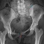 Widening and offset of the pubic symphysis (red arrow) and left sacroiliac joint (yellow arrow). Fractures of the right superior (white arrow) and inferior (gray arrow) pubic rami. Displaced fractures of the left sacral ala (blue arrow) and left L5 transverse process (black arrow).