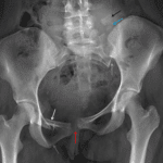 Widening and offset of the pubic symphysis (red arrow) and left sacroiliac joint (yellow arrow). Fractures of the right superior (white arrow) and inferior (purple arrow) pubic rami. Displaced fractures of the left sacral ala (blue arrow) and left L5 transverse process (black arrow).