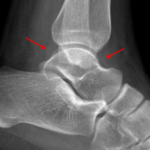 Red arrows demonstrate subtle increased density anterior and posterior to the tibiotalar joint, suggesting the presence of an ankle joint effusion.