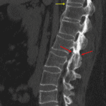 Red arrows: acute nondisplaced fracture through the fused posterior elements at L2-L3. Yellow arrow: nondisplaced fracture through an anterior bridging syndesmophyte at T11-T12.