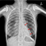 Red arrows: left lower lobe collapse with medial displacement of the collapsed lobe.