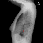 Red arrow: collapsed left lower lobe overlying the posterior left hemidiaphragm resulting in loss of the normal silhouette.