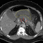 Areas of hypoenhancement involving the pancreatic head/neck, body, and tail (red arrows). The lesser sac collection is outlined in yellow.