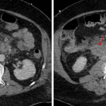 Mural thickening of the second and third segments of the duodenum (red arrows).