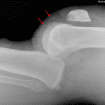 Tiny ossific fragments anterior to the femoral condyles (red arrows).