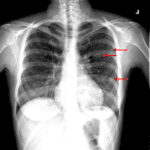 Left lung nodules, the most medial of which appears cavitary (red arrows).