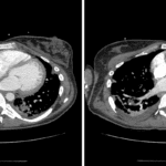 Examples of bilateral subsegmental pulmonary arterial filling defects in this patient (red arrows).