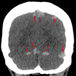 Abnormally hyperattenuating appearance of many of the intracranial veins and venous sinuses (red arrows), concerning for thrombosis.