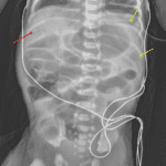 Red arrow: multiple branching lucencies overlying the liver consistent with portal venous gas. Yellow arrows: curvilinear and mottled lucencies along bowel loops in the left upper quadrant.