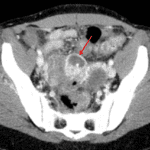 Red arrow: tubular, fluid-filled structure with mural hyperenhancement associated with the right ovary.