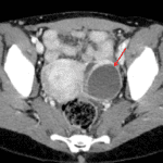 Red arrow: Cystic structure in the left ovary.