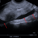 Red arrows: free fluid layering in the pelvis, which extends posterior to the uterus.