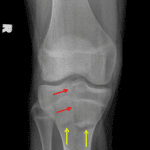Red arrows: vertically oriented fracture extending through the epiphysis, physis, and into the metaphysis. Yellow arrows: horizontally-oriented fracture through the metaphysis.