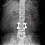 Red arrows indicate left renal calculi.