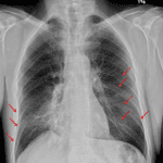Red arrows indicate multiple remote bilateral rib fractures.