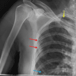 Red arrows: displaced right lateral fifth and sixth rib fractures. Blue arrow: right anterior fourth rib fracture. Yellow arrow: small right apical pneumothorax.