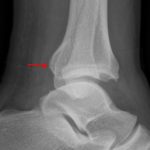 Red arrow: nondisplaced fracture of the posterior malleolus.