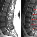 Comparing the sagittal pre-contrast (left) and post-contrast (right) T1-weighted images, there is clear diffuse enhancement of the cauda equina nerve roots (red arrows).