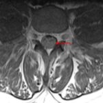 An axial post-contrast T1-weighted image demonstrates diffuse enhancement of the cauda equina nerve roots (enhancing more avidly than the reference paraspinal muscles) and enlargement of the nerve roots, which nearly completely fill the thecal sac.