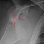 Hill-Sachs fracture, which is not particularly well seen due to overlapping osseous structures.