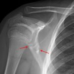 Oblique scapular body fracture (red arrows).