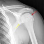 Mild flattening of the posterior humeral head consistent with a Hill-Sachs fracture (red arrow). Mild displaced bony Bankart along the inferior glenoid rim (yellow arrow).