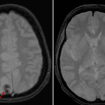 Foci of susceptibility artifact along the bilateral parietooccipital cortex (red arrows), consistent with small areas of hemorrhage.