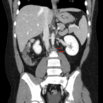 Duplicated left renal collecting system with 2 left ureters (red arrows).