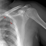 Left first and second rib fractures (red arrows).