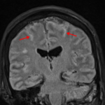Hyperintense FLAIR signal within cerebral sulci bilaterally (red arrows).