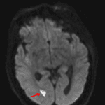 Restricted diffusion within the occipital horn of the right lateral ventricle (red arrow), concerning for ventriculitis.