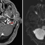 Peripherally enhancing collection (left image, red arrow) with restricted diffusion (right image, red arrow), concerning for an abscess in the left mastoid temporal bone.