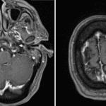 Filling defects within the right transverse sinus (left image, red arrow) and superior sagittal sinus (right image, red arrow) consistent with areas of venous sinus thrombosis.